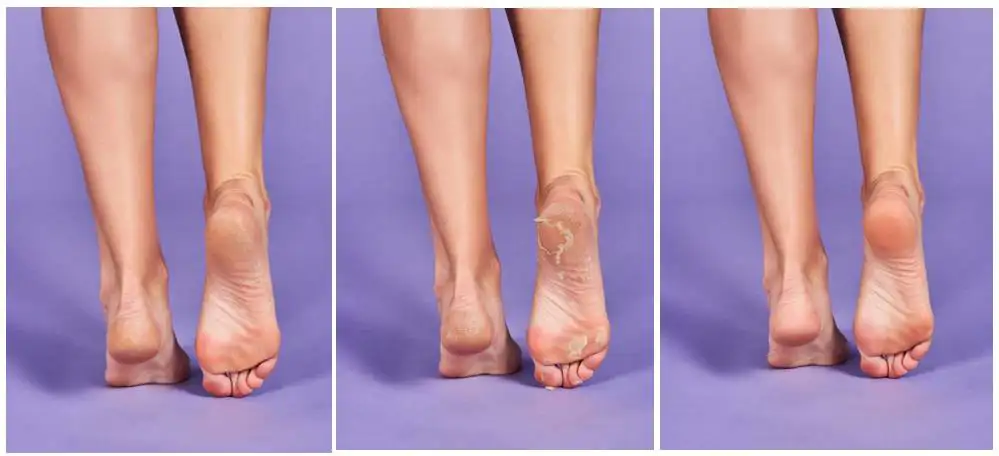 5  Proceso Peeling